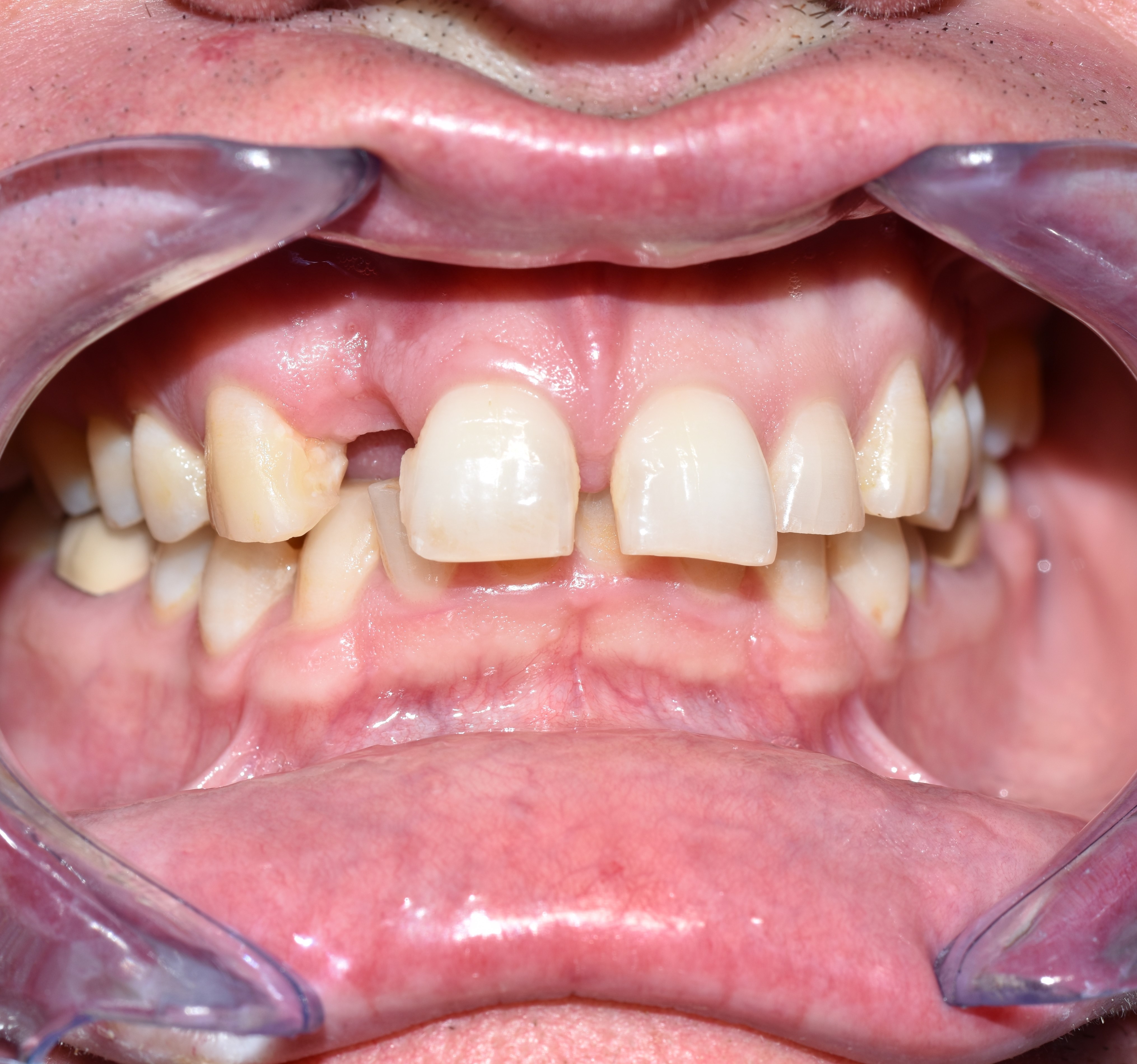 Before treatment